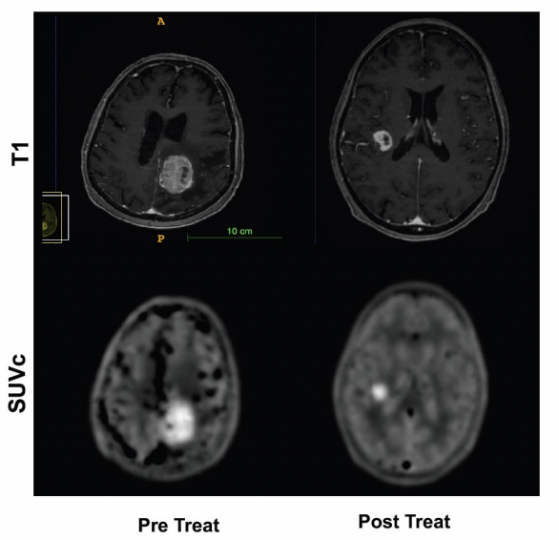 Radiopharm Theranostics welcomes additional data from Phase 2a brain metastases trial